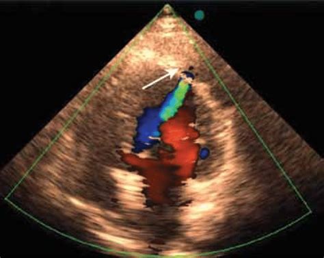 2D Doppler Echocardiogram with Color Flow .